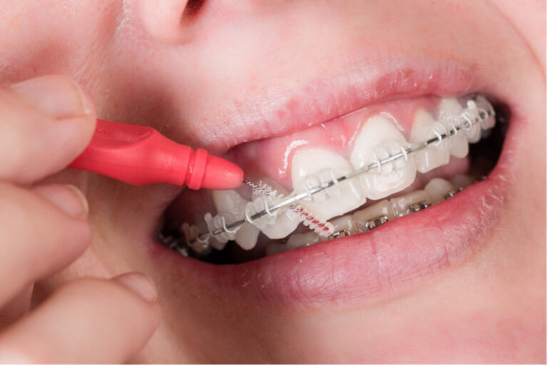 Como Limpar Os Dentes Depois De Tirar O Aparelho