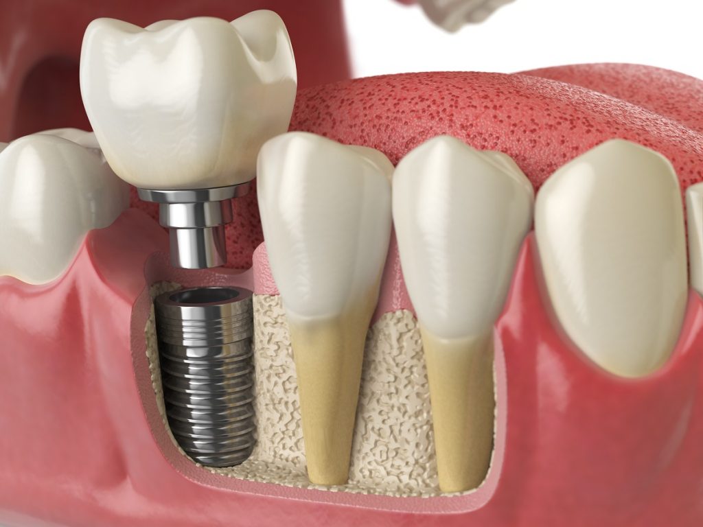 Imagem demonstrativa: Um desenho de uma prótese dentária prestes a ser parafusada de Quanto custa um implante dentario
